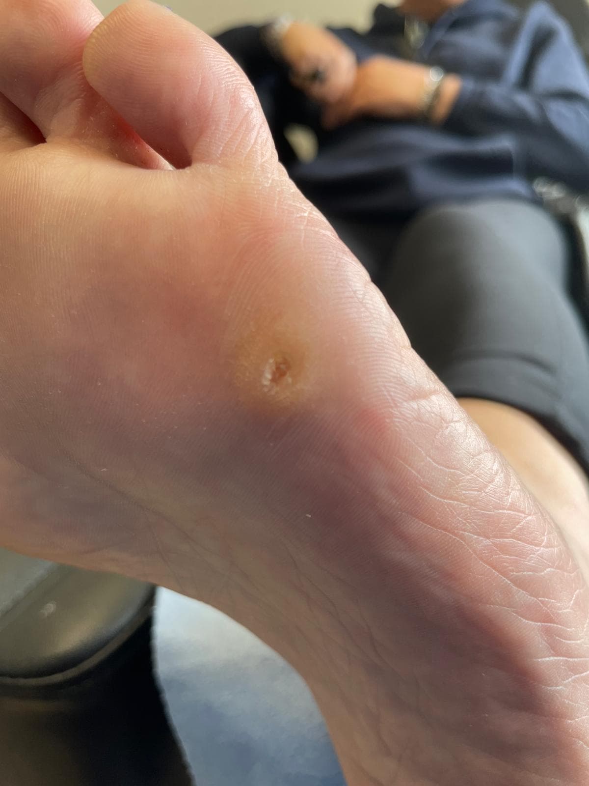 Corn Treatment (Heloma Durum) after treatment