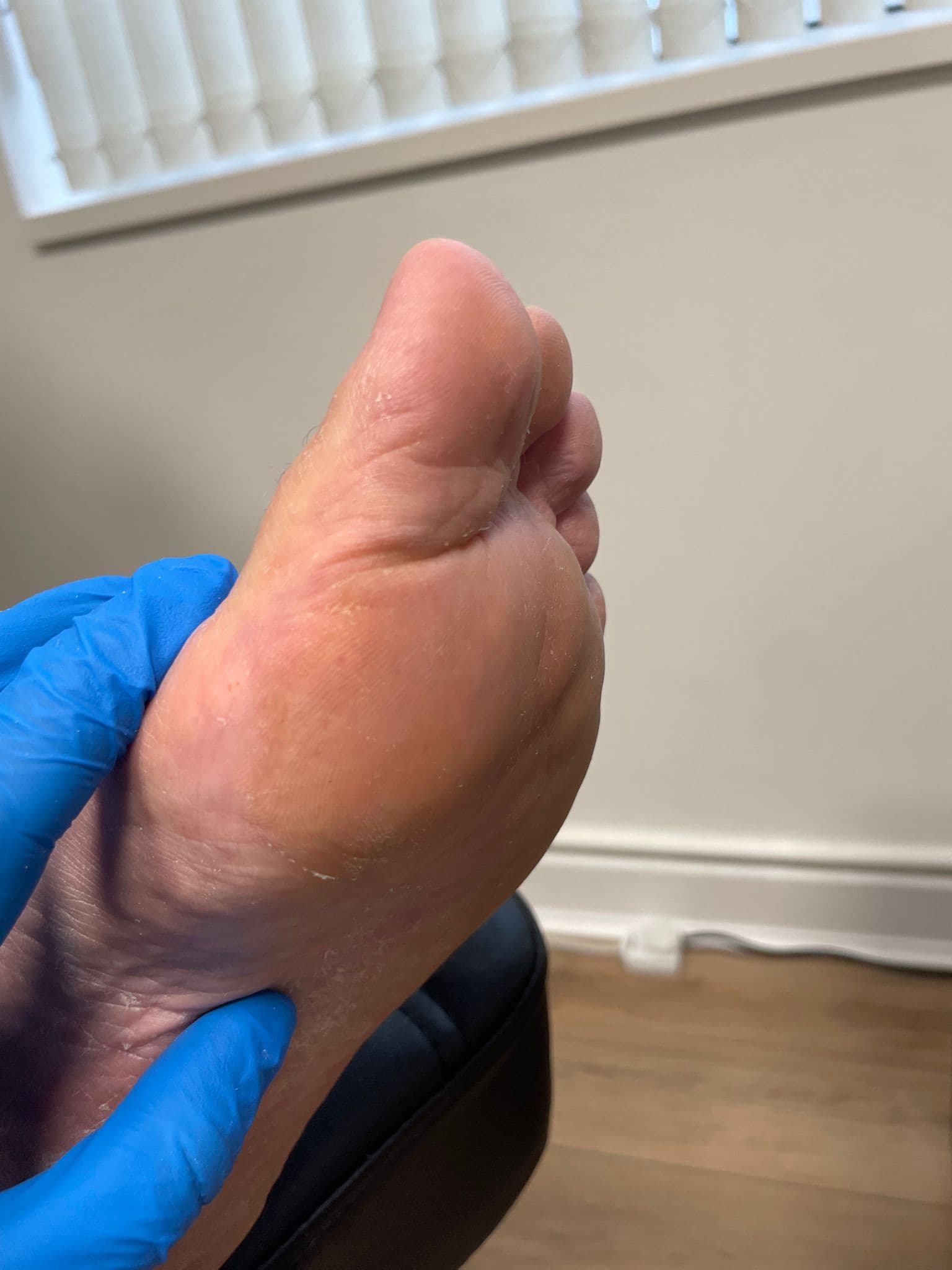Hard Skin (Callus) Treatment after treatment